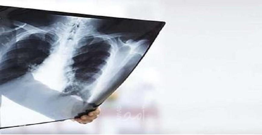 علاج للسل بتكلفة 1040 دولاراً للجرعة كاملة