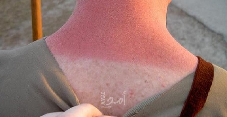 الأماكن المعرضة فى الجسم لحروق الشمس