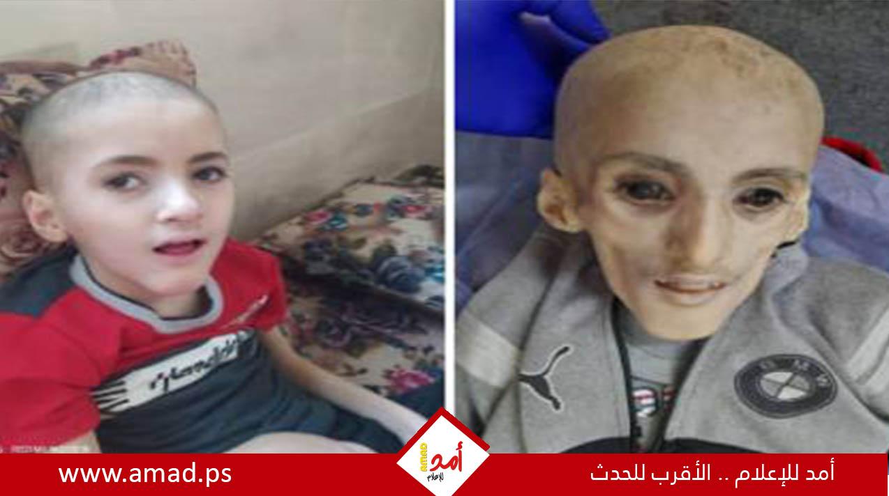 وفاة الطفل يزن الكفارنة تصدح بمأساة الجوع في غزة
