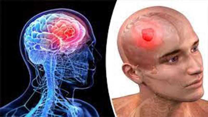 أعراض سرطان الرأس والرقبة وطرق العلاج