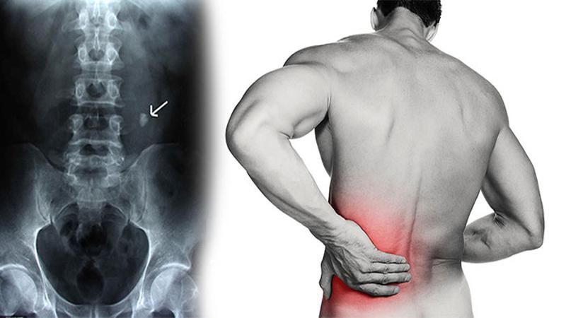 كيف تعالج حصوات المرارة فى 7 خطوات