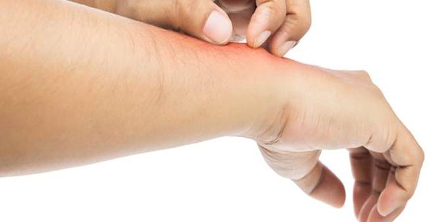 أشياء تزيد من أعراض الصدفية .. تعرف
