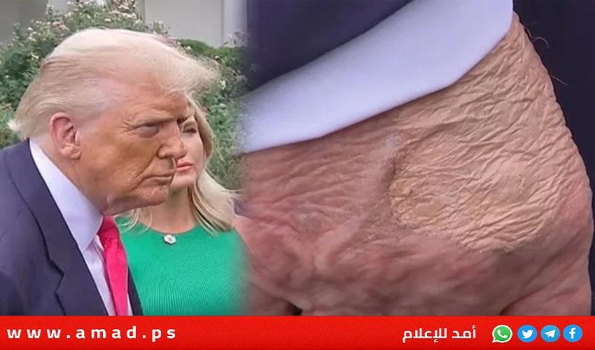 البيت الأبيض يكشف الحالة الصحية لترامب والأورام على يديه