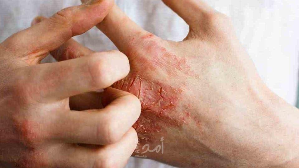 أشهر مشاكل الصيف الجلدية