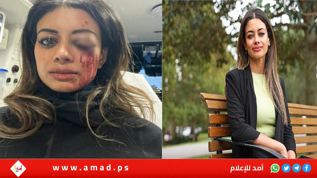 أستراليا.. هانا توماس مرشحة سابقة لـ"الخضر" قد تفقد بصرها من أجل فلسطين! صور