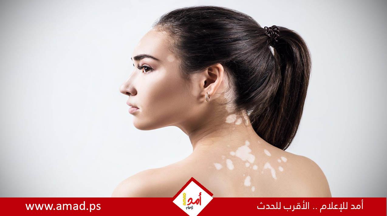الأعراض وطرق التعامل مع مرض البهاق
