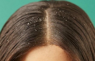 وصفات طبيعية لعلاج قشرة الشعر
