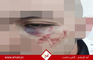 شرطة الاحتلال تعترف بحفر عناصرها "نجمة داوود" على وجه شاب فلسطيني! صور