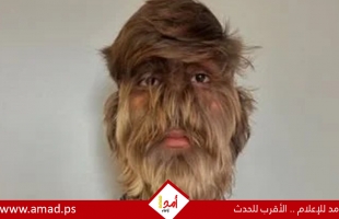 هندى يدخل موسوعة جينيس لإصابته بـ"متلازمة المستذئب"