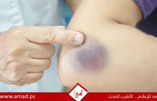 3 أسباب وراء الإصابة بالأورام الدموية