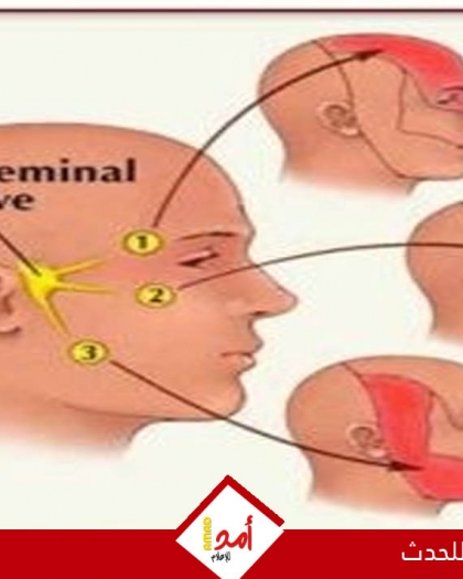 علامات الإصابة بالتهاب العصب ثلاثي التوائم